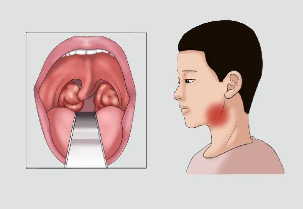 秋天雾霾严峻易患病？教你4招做到科学防护，少患病！